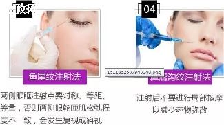 botox_עbotoxʲôҪע